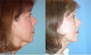 Lower Facelift, Brow Re-positioning, Upper Eyelid Surgery 366963