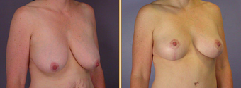 Breast Implants before 271087