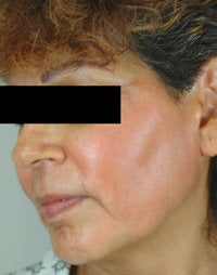 Melasma Treatment after 120088