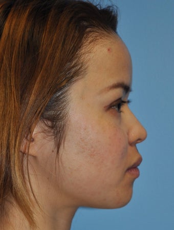 Rhinoplasty-Asian before 371839
