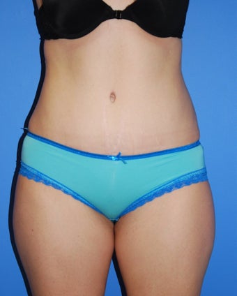 Abdominoplasty after 343059
