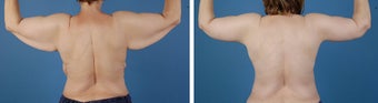 Arm lift (Brachioplasty) 303698