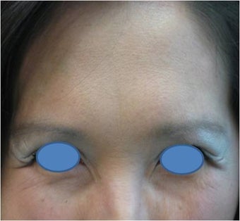 Botox after 83023