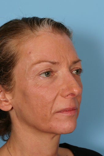 Fraxel Laser treatment before 88693
