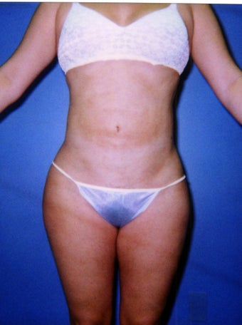 liposuction of abdomen and flanks of woman from Los Angeles after 583292