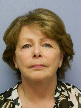 Lower Face with Neck Lift after 598901