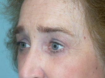 Upper and Lower Lid Blepharoplasty and Cheeklift after 148580