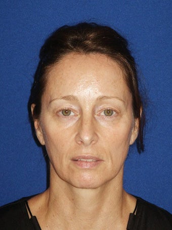 Facelift, Endoscopic Browlift, Upper and Lower Blepharoplasty before 248888