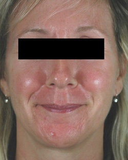 Pulsed Dye Laser Treatments for Rosacea before 104196