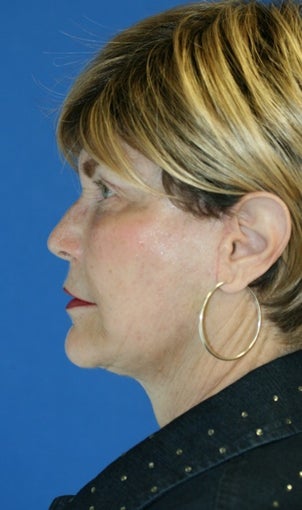1 month post op: Facelift, Necklift, Browlift, Fat Transfer, Upper Bleph 456304