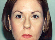 Chemical Brow Lift after 568456