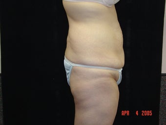 Body Lift with Liposuction of Abdomen, Waist, and Flanks before 203455