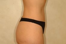 Body Lift after 87349