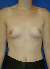 Breast Augmentation Surgery before 157909