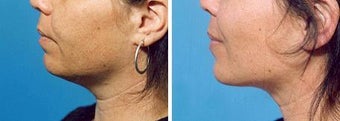 Chin Liposuction before 640744