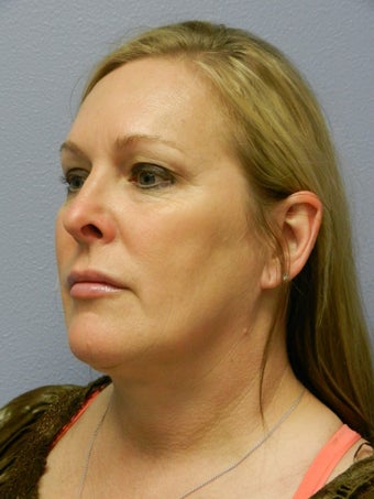 Laser Liposuction after 555894