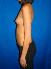 Breast Augmentation 353463
