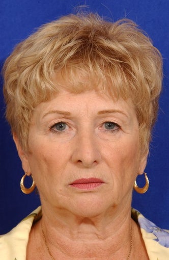 Face-necklift, Superficial cheeklift, upper blepharoplasty before 81614