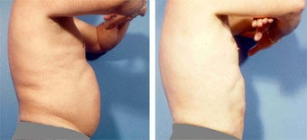 Liposuction before 636169