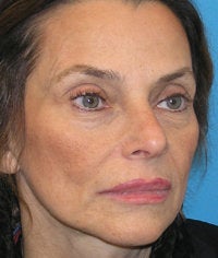 Midfacial Rejuvenation before 52478
