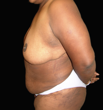 Tummy Liposuction after 230743