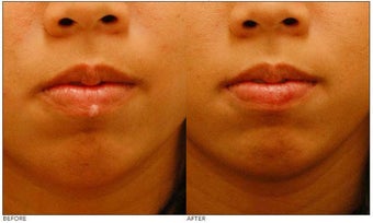 Mole Removal before 138530