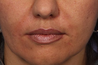 Radiesse to Smile Lines (nasolabial folds) after 308319