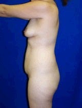 Tummy Tuck (Abdominoplasty), Breast Enhancement 429758