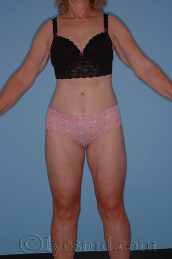Lower Body Lift with Tumescent Liposuction after 233082