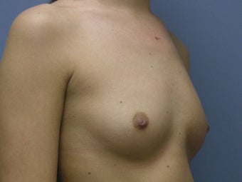 Breast Augmentation 510237