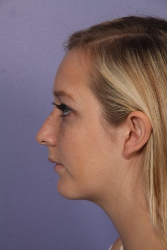 Chin Augmentation and Liposuction of the Neck after 611677