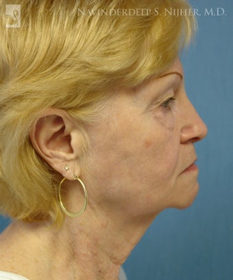 Facelift, Eyelid Surgery & Chin Implant before 501564