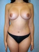 Breast Augmentation, Petite Frame Breast Augmentation, Tummy Tuck (Abdominoplasty) after 467906
