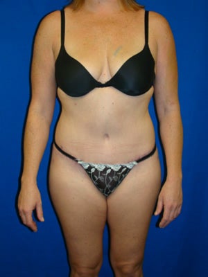 Tummy Tuck Surgery (abdominoplasty) after 142009