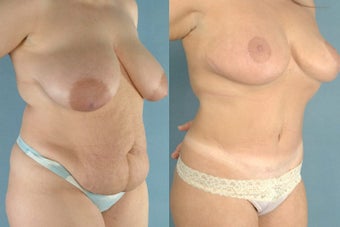 Abdminoplasty/Breast Reduction/Areola Reduction before 100268