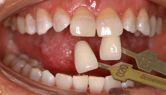 Teeth Whitening after 306937