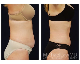 Abdominoplasty - Tummy Tuck 396017