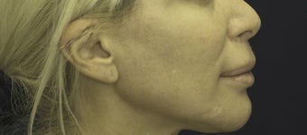 Lip Lift 606645