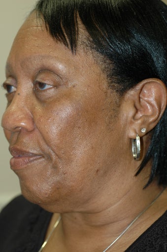 Neck lift, face lift, eyelid surgery before 437154