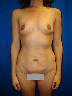Tummy Tuck Surgery (abdominoplasty) and Breast Implants before 139398