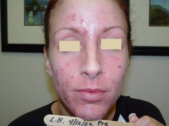 SmoothBeam Laser for Acne before 152217