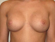 Bilateral Breast Augmentation after 112070