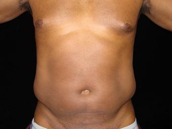 Liposuction of Abdomen, Waist, Flanks with 6 Pack Abdominal Etching before 203523