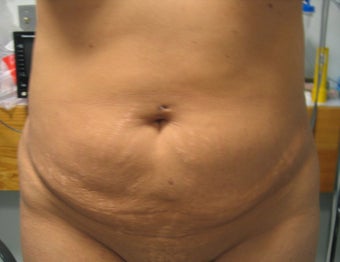 Abdominoplasty before 163980