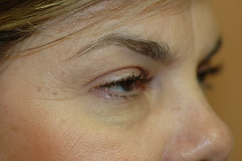 Midface lift, upper and lower eyelid surgery, Hetter resurfacing chemical peel before 433480
