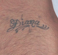 Los Angeles Tattoo Removal before 151339