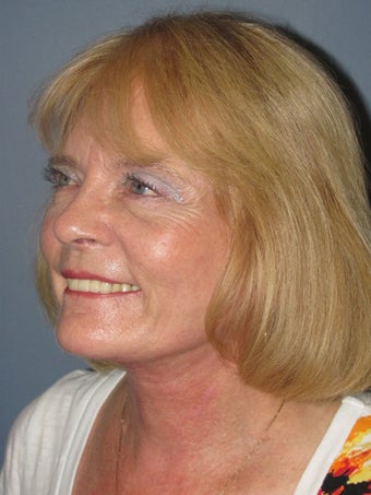 Neck Lift, Platysmaplasty 634746