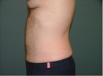 Tummy Tuck 97007