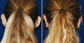Ear Surgery after 495868