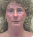 Face and Brow Lift and Eyelid Surgery before 149153